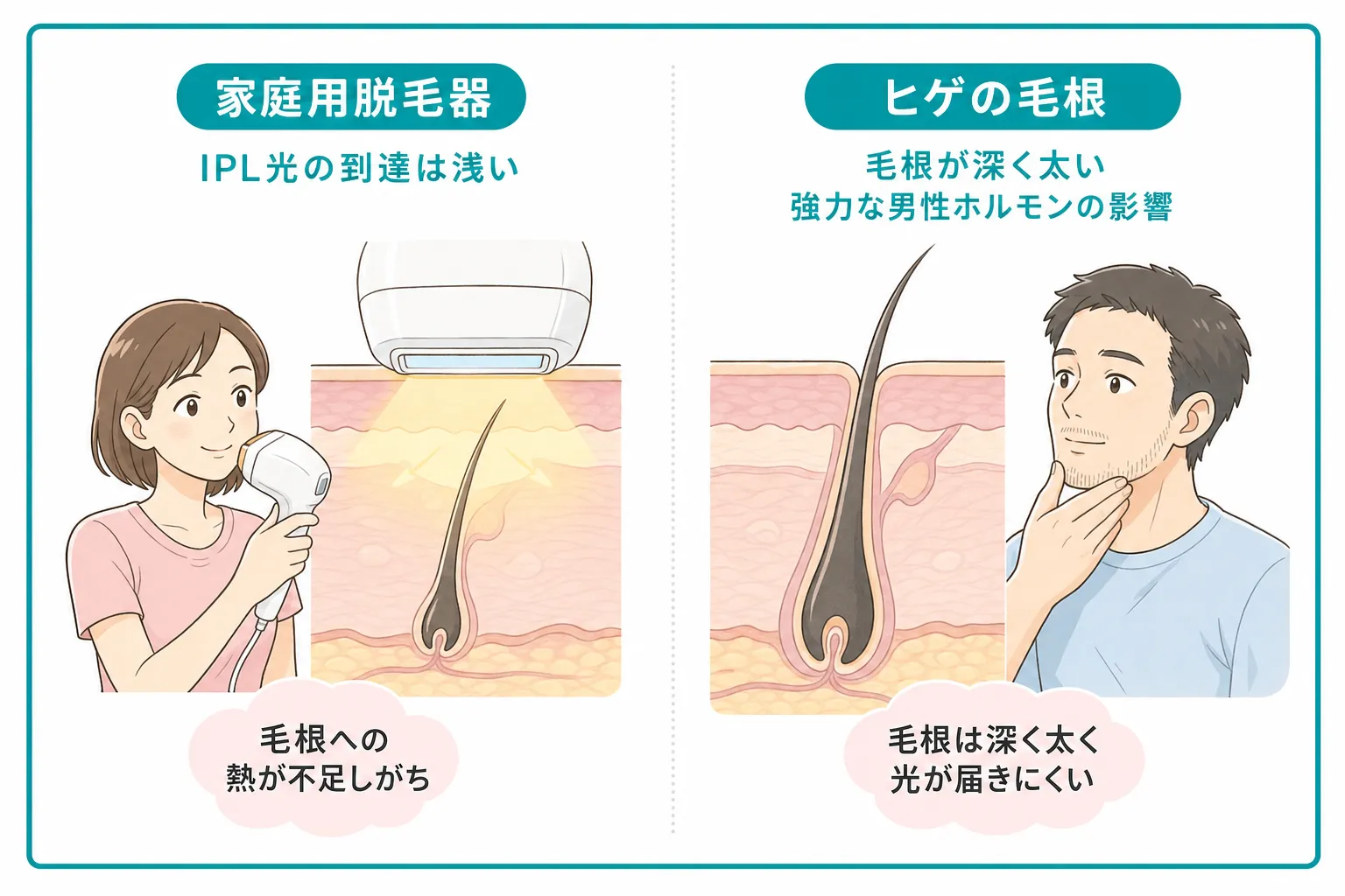 家庭用脱毛器がヒゲに効果を感じにくい理由